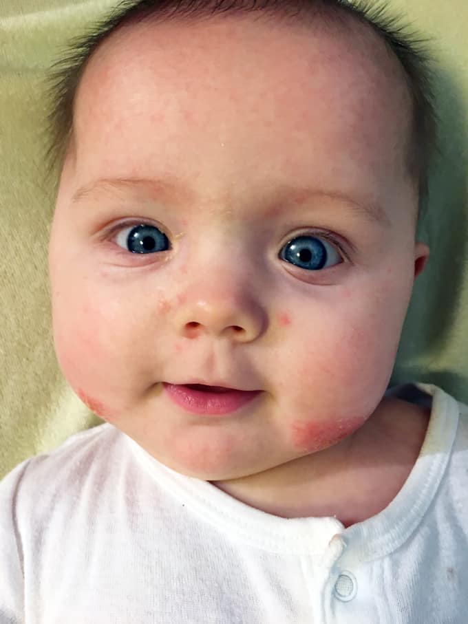 Baby rash